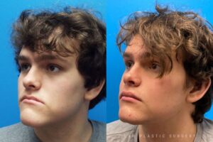 Jaw Surgery Before and After Photo. Surgery performed in Dallas, TX at Law Plastic Surgery.