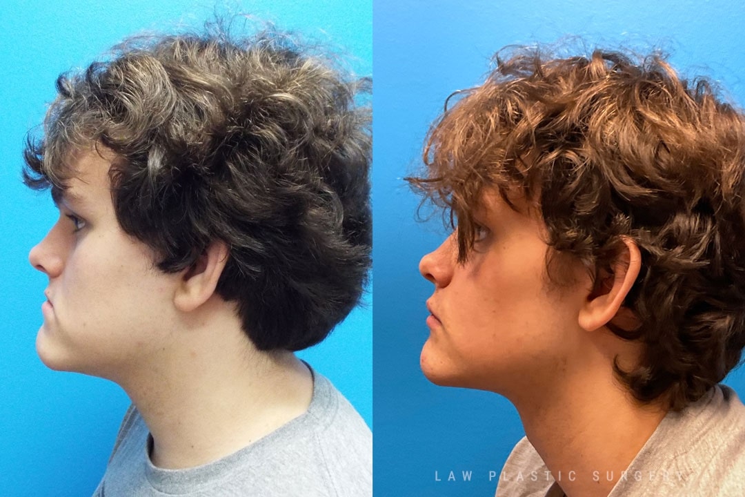 Jaw Surgery Before and After Photo. Surgery performed in Dallas, TX at Law Plastic Surgery.