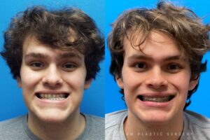 Jaw Surgery Before and After Photo. Surgery performed in Dallas, TX at Law Plastic Surgery.