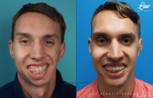 Jaw Surgery Before and After Photo. Surgery performed in Dallas, TX at Law Plastic Surgery.