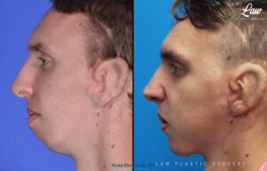 Jaw Surgery Before and After Photo. Surgery performed in Dallas, TX at Law Plastic Surgery.
