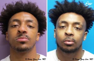 Jaw Surgery Before and After Photo. Surgery performed in Dallas, TX at Law Plastic Surgery.