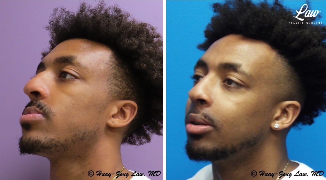 Jaw Surgery Before and After Photo. Surgery performed in Dallas, TX at Law Plastic Surgery.