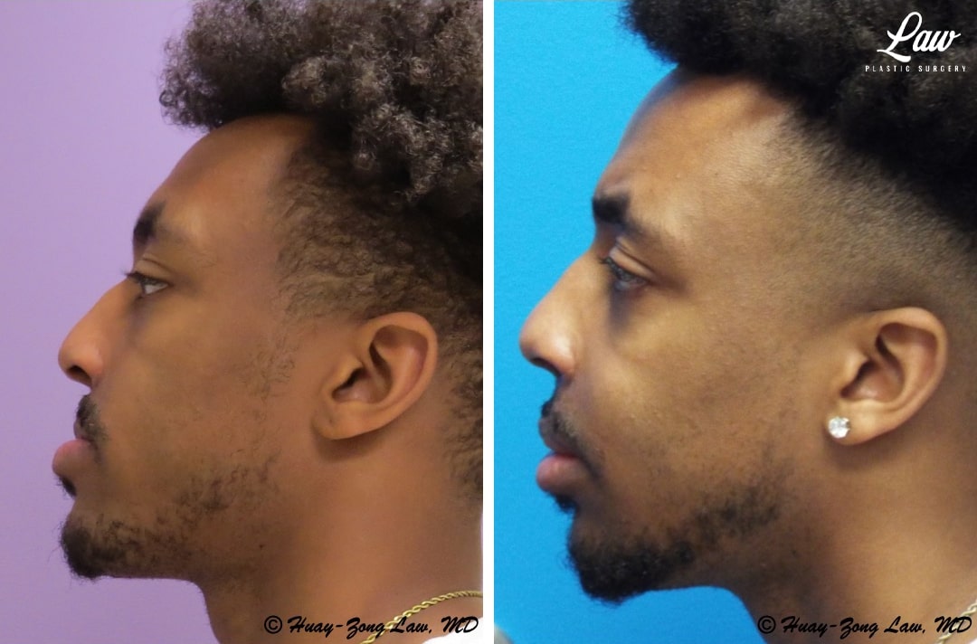Jaw Surgery Before and After Photo. Surgery performed in Dallas, TX at Law Plastic Surgery.