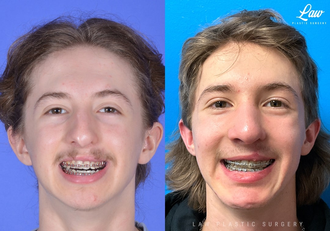 Jaw Surgery Before and After Photo. Surgery performed in Dallas, TX at Law Plastic Surgery.