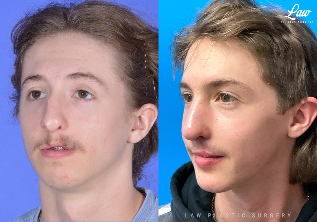 Jaw Surgery Before and After Photo. Surgery performed in Dallas, TX at Law Plastic Surgery.