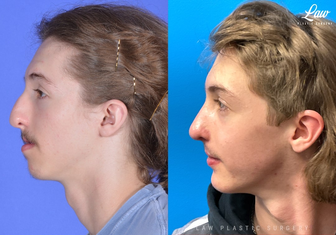 Jaw Surgery Before and After Photo. Surgery performed in Dallas, TX at Law Plastic Surgery.