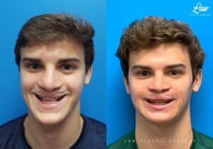 Jaw Surgery Before and After Photo. Surgery performed in Dallas, TX at Law Plastic Surgery.