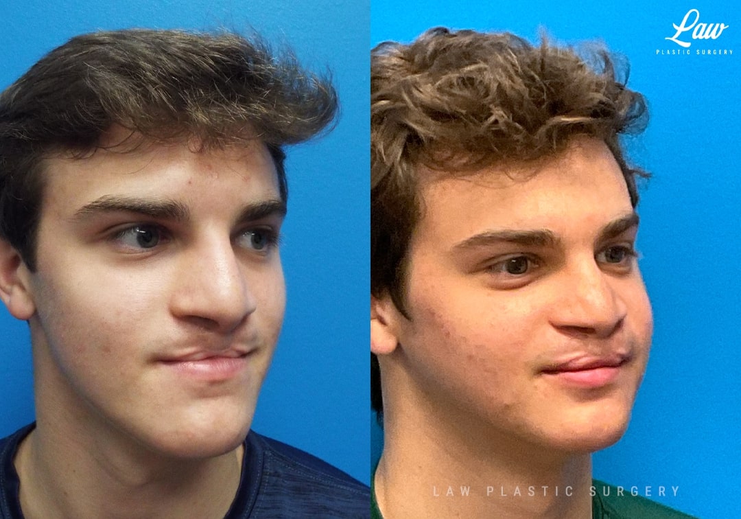 Jaw Surgery Before and After Photo. Surgery performed in Dallas, TX at Law Plastic Surgery.