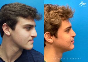 Jaw Surgery Before and After Photo. Surgery performed in Dallas, TX at Law Plastic Surgery.