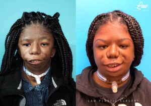 Jaw Surgery Before and After Photo. Surgery performed in Dallas, TX at Law Plastic Surgery.