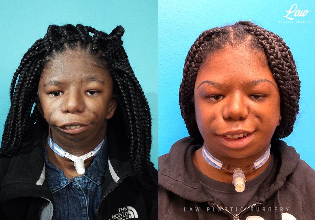Jaw Surgery Before and After Photo. Surgery performed in Dallas, TX at Law Plastic Surgery.