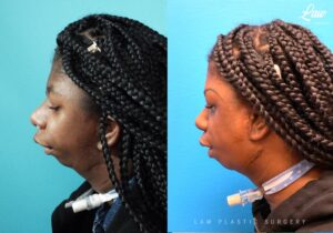Jaw Surgery Before and After Photo. Surgery performed in Dallas, TX at Law Plastic Surgery.