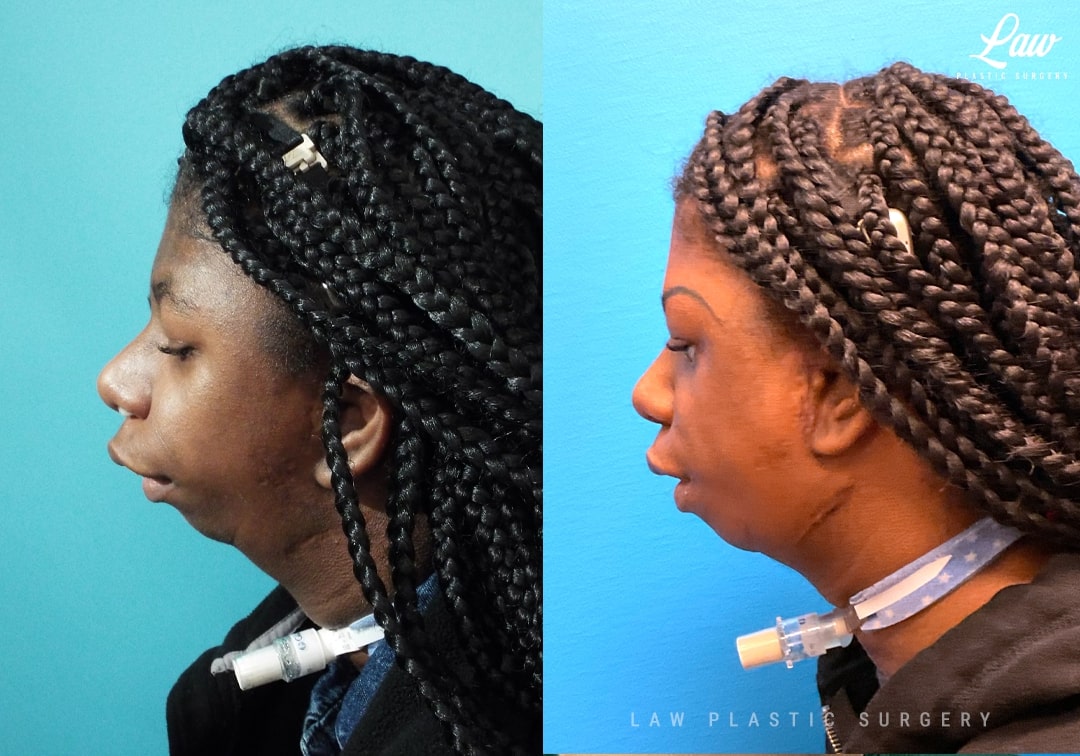 Jaw Surgery Before and After Photo. Surgery performed in Dallas, TX at Law Plastic Surgery.