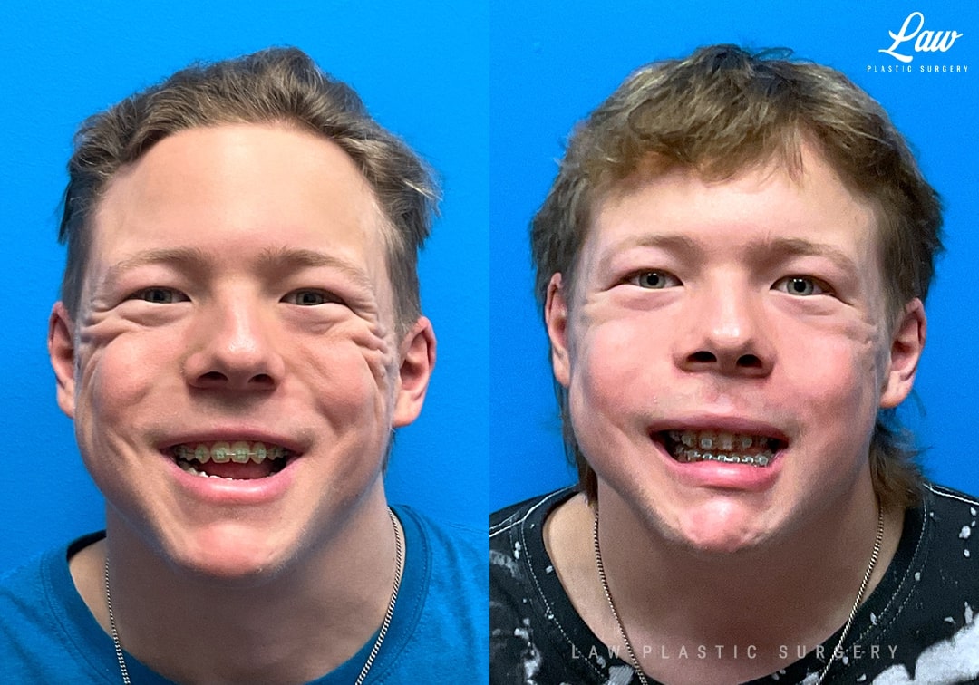 Jaw Surgery Before and After Photo. Surgery performed in Dallas, TX at Law Plastic Surgery.
