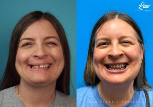 Jaw Surgery Before and After Photo. Surgery performed in Dallas, TX at Law Plastic Surgery.