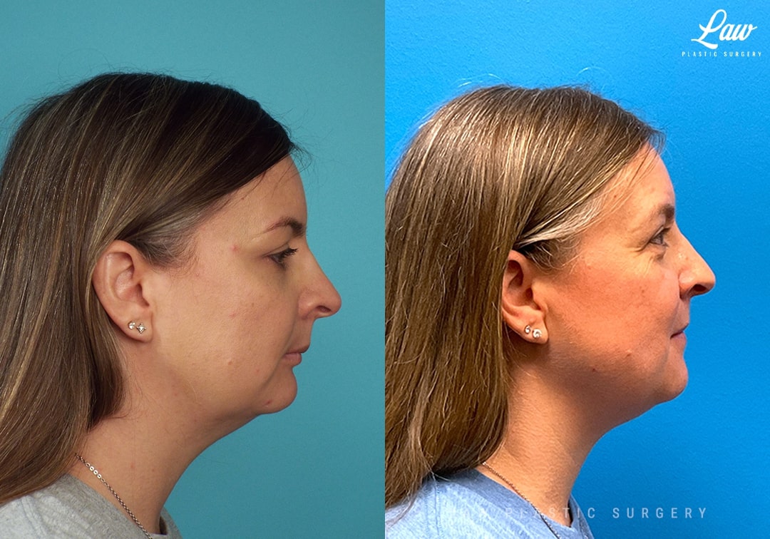 Jaw Surgery Before and After Photo. Surgery performed in Dallas, TX at Law Plastic Surgery.