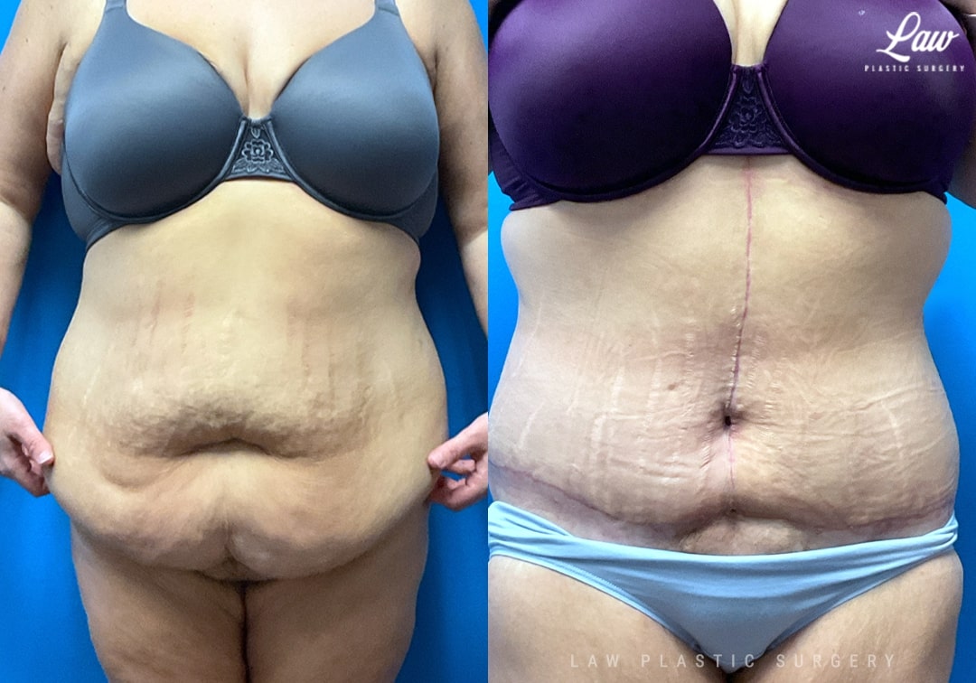 Tummy Tuck (Abdominoplasty) Before and After Photo. Surgery performed in Dallas, TX at Law Plastic Surgery.