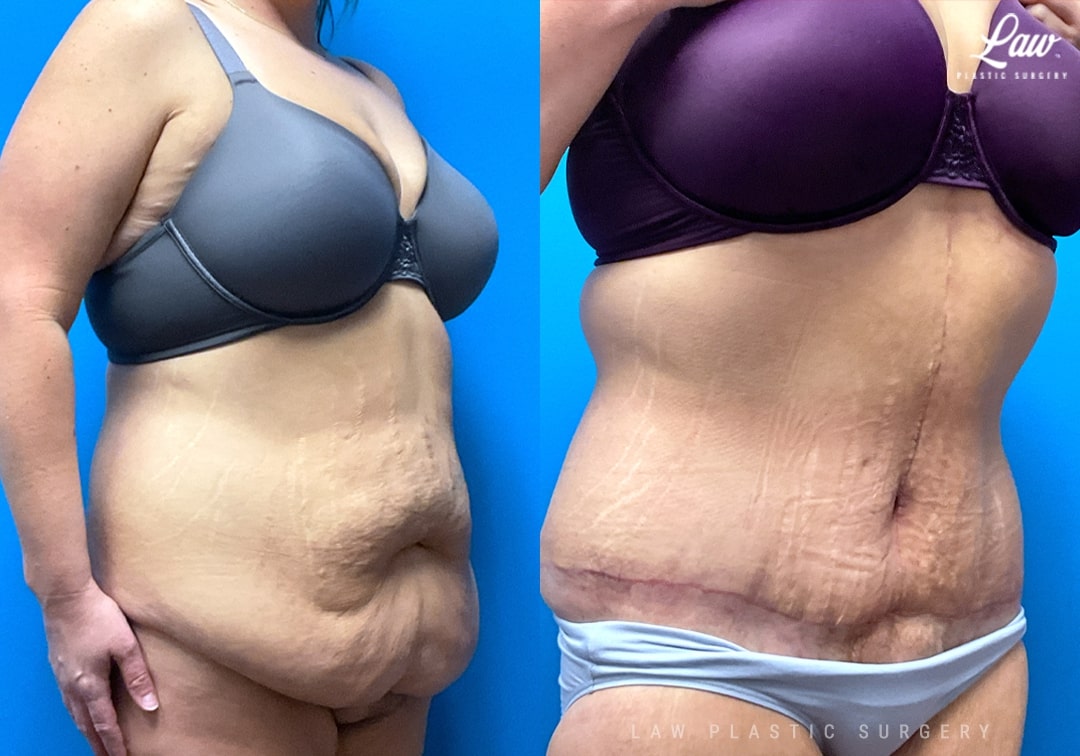 Tummy Tuck (Abdominoplasty) Before and After Photo. Surgery performed in Dallas, TX at Law Plastic Surgery.