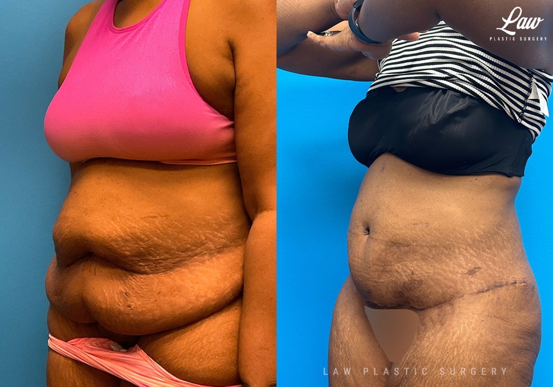 Tummy Tuck (Abdominoplasty) Before and After Photo. Surgery performed in Dallas, TX at Law Plastic Surgery.