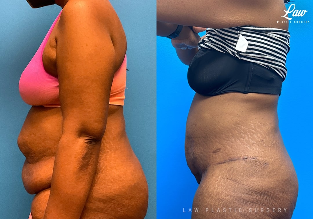 Tummy Tuck (Abdominoplasty) Before and After Photo. Surgery performed in Dallas, TX at Law Plastic Surgery.