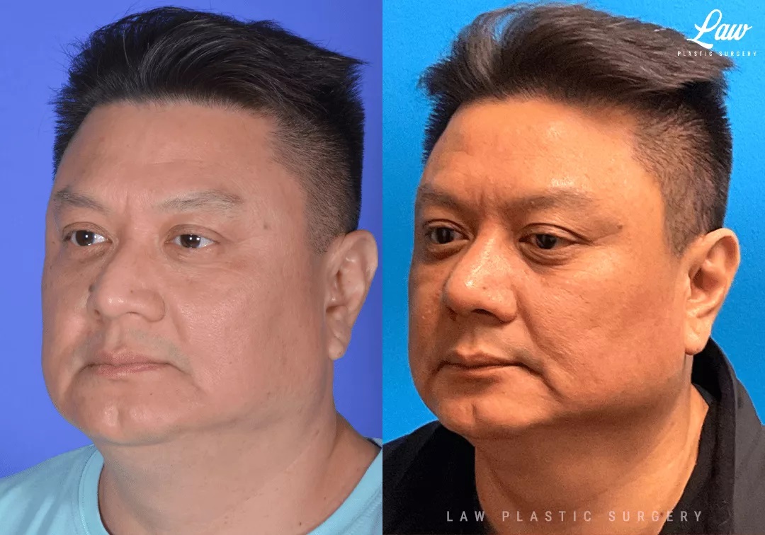Asian Rhinoplasty Before and After Photo. Surgery performed in Dallas, TX at Law Plastic Surgery.