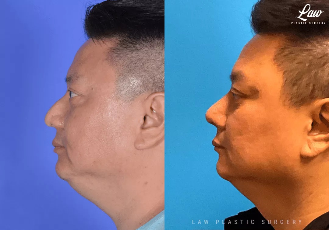 Asian Rhinoplasty Before and After Photo. Surgery performed in Dallas, TX at Law Plastic Surgery.