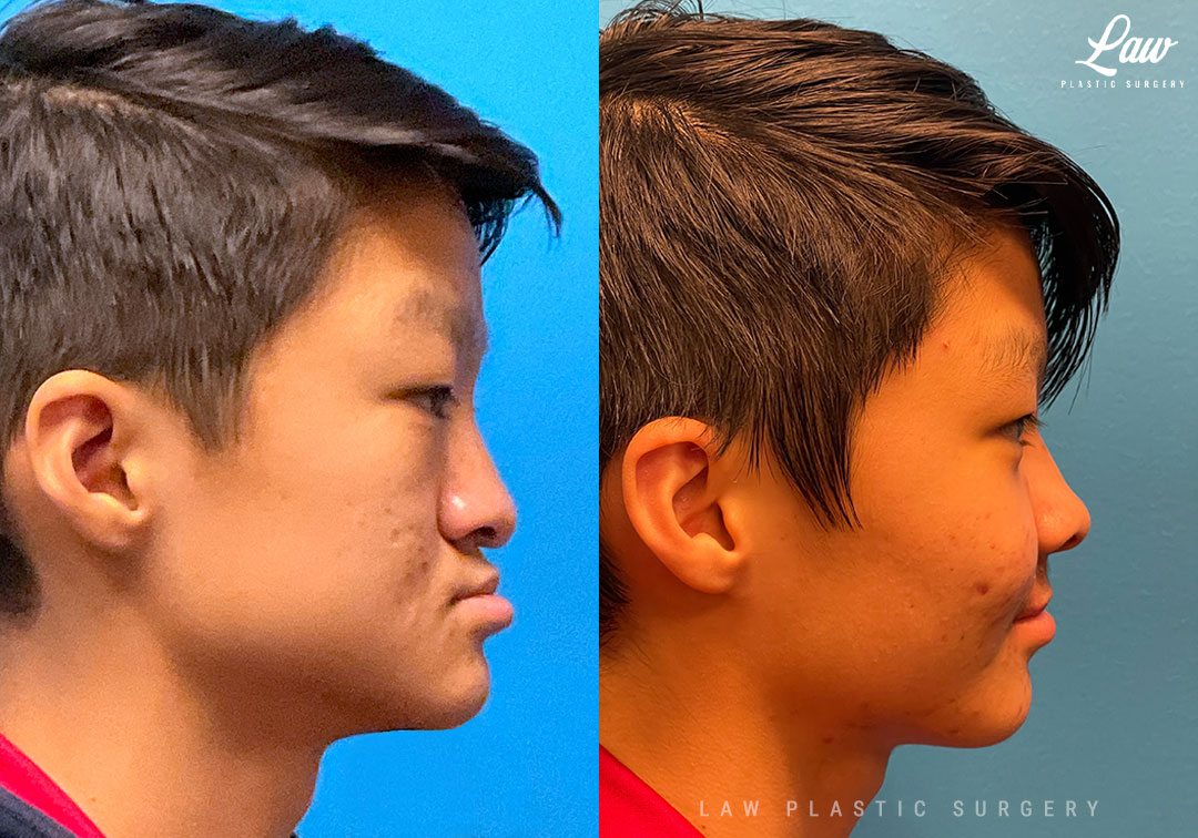 Asian Rhinoplasty Before and After Photo. Surgery performed in Dallas, TX at Law Plastic Surgery.