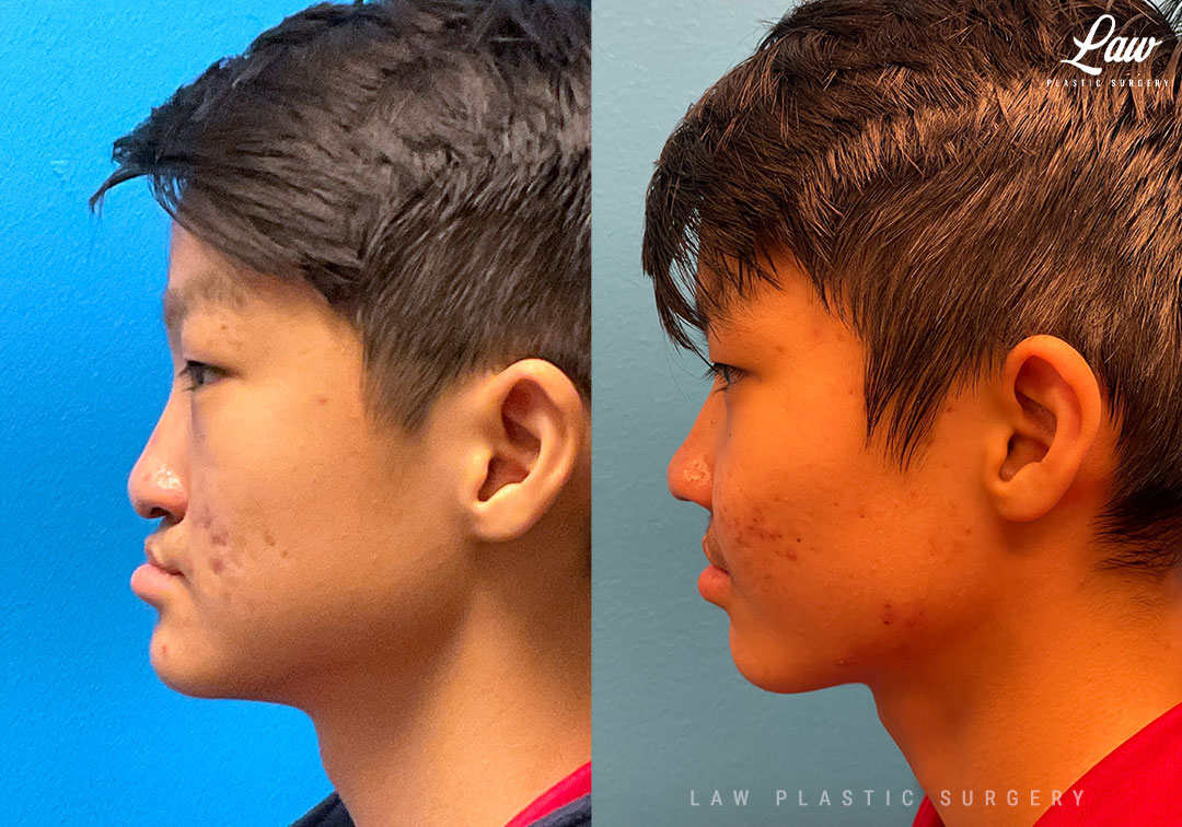 Asian Rhinoplasty Before and After Photo. Surgery performed in Dallas, TX at Law Plastic Surgery.