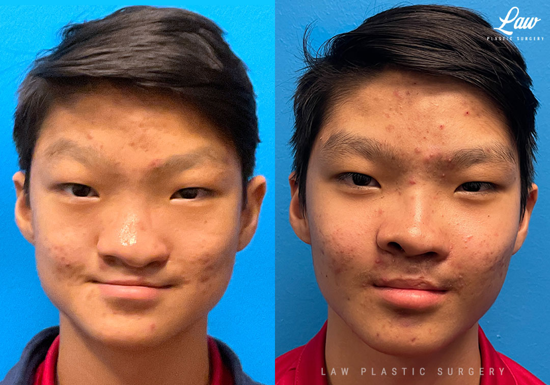 Asian Rhinoplasty Before and After Photo. Surgery performed in Dallas, TX at Law Plastic Surgery.