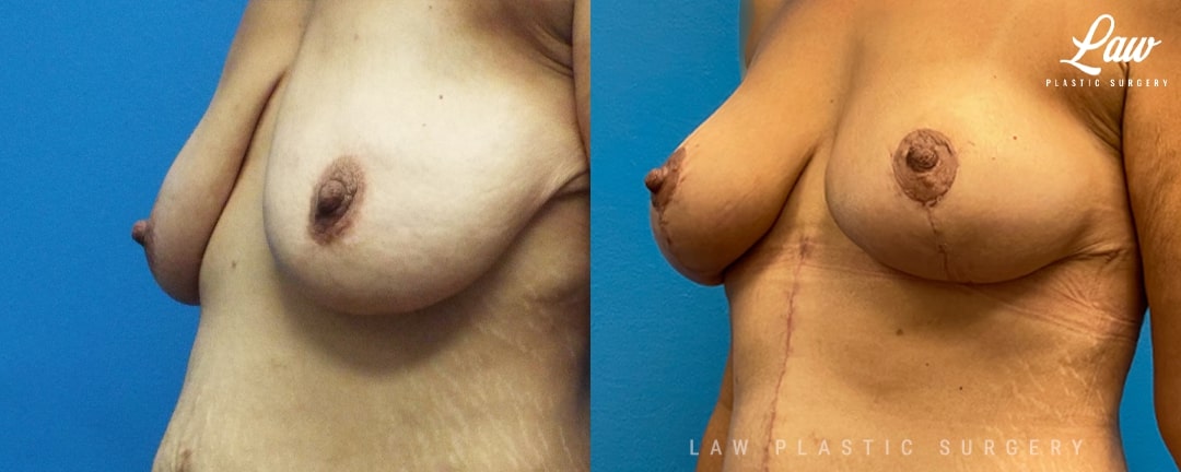 Breast Lift (Mastopexy) Before and After Photo. Surgery performed in Dallas, TX at Law Plastic Surgery.