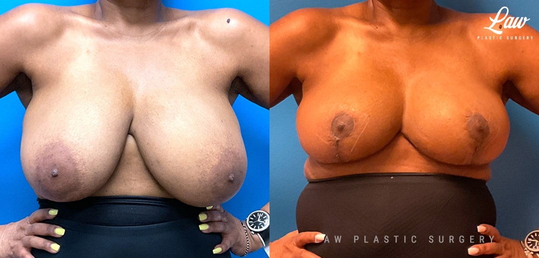 Breast Lift (Mastopexy) Before and After Photo. Surgery performed in Dallas, TX at Law Plastic Surgery.