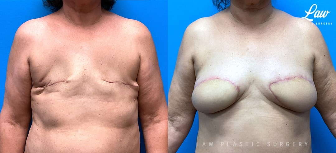 Breast Reconstruction Before and After Photo. Surgery performed in Dallas, TX at Law Plastic Surgery.
