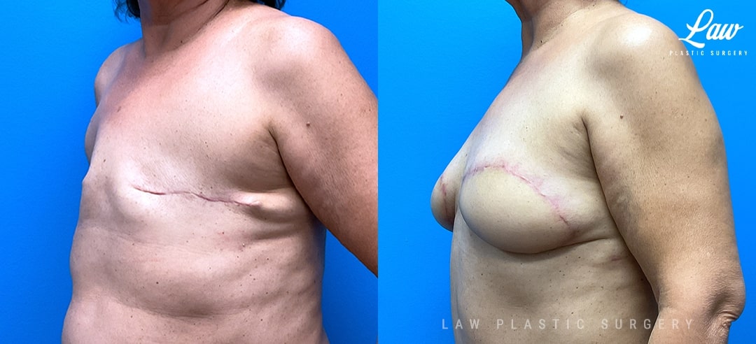 Breast Reconstruction Before and After Photo. Surgery performed in Dallas, TX at Law Plastic Surgery.