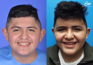 Craniosynostosis Before and After Photo. Surgery performed in Dallas, TX at Law Plastic Surgery.