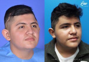 Craniosynostosis Before and After Photo. Surgery performed in Dallas, TX at Law Plastic Surgery.