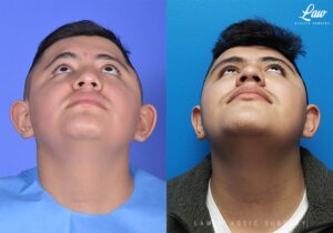Craniosynostosis Before and After Photo. Surgery performed in Dallas, TX at Law Plastic Surgery.