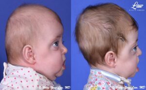 Craniosynostosis Before and After Photo. Surgery performed in Dallas, TX at Law Plastic Surgery.
