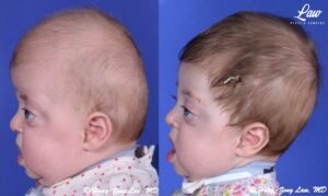 Craniosynostosis Before and After Photo. Surgery performed in Dallas, TX at Law Plastic Surgery.