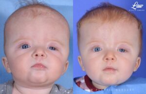 Craniosynostosis Before and After Photo. Surgery performed in Dallas, TX at Law Plastic Surgery.