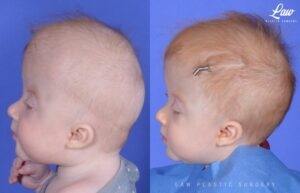 Craniosynostosis Before and After Photo. Surgery performed in Dallas, TX at Law Plastic Surgery.