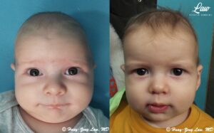 Craniosynostosis Before and After Photo. Surgery performed in Dallas, TX at Law Plastic Surgery.
