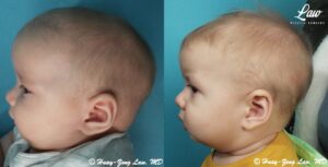 Craniosynostosis Before and After Photo. Surgery performed in Dallas, TX at Law Plastic Surgery.