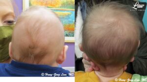 Craniosynostosis Before and After Photo. Surgery performed in Dallas, TX at Law Plastic Surgery.