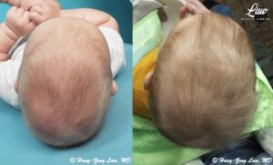 Craniosynostosis Before and After Photo. Surgery performed in Dallas, TX at Law Plastic Surgery.