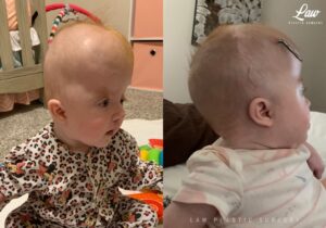 Craniosynostosis Before and After Photo. Surgery performed in Dallas, TX at Law Plastic Surgery.