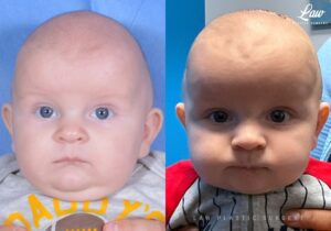 Craniosynostosis Before and After Photo. Surgery performed in Dallas, TX at Law Plastic Surgery.