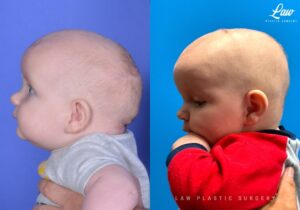 Craniosynostosis Before and After Photo. Surgery performed in Dallas, TX at Law Plastic Surgery.