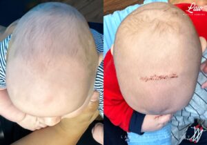 Craniosynostosis Before and After Photo. Surgery performed in Dallas, TX at Law Plastic Surgery.