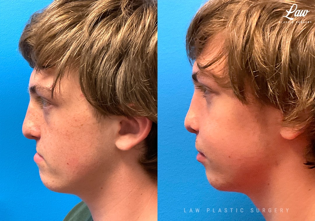 Jaw Distraction Before and After Photo. Surgery performed in Dallas, TX at Law Plastic Surgery.